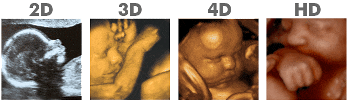 2d ultrasound, 3d ultrasound, 4d ultrasound and hd ultrasouond comparison photos